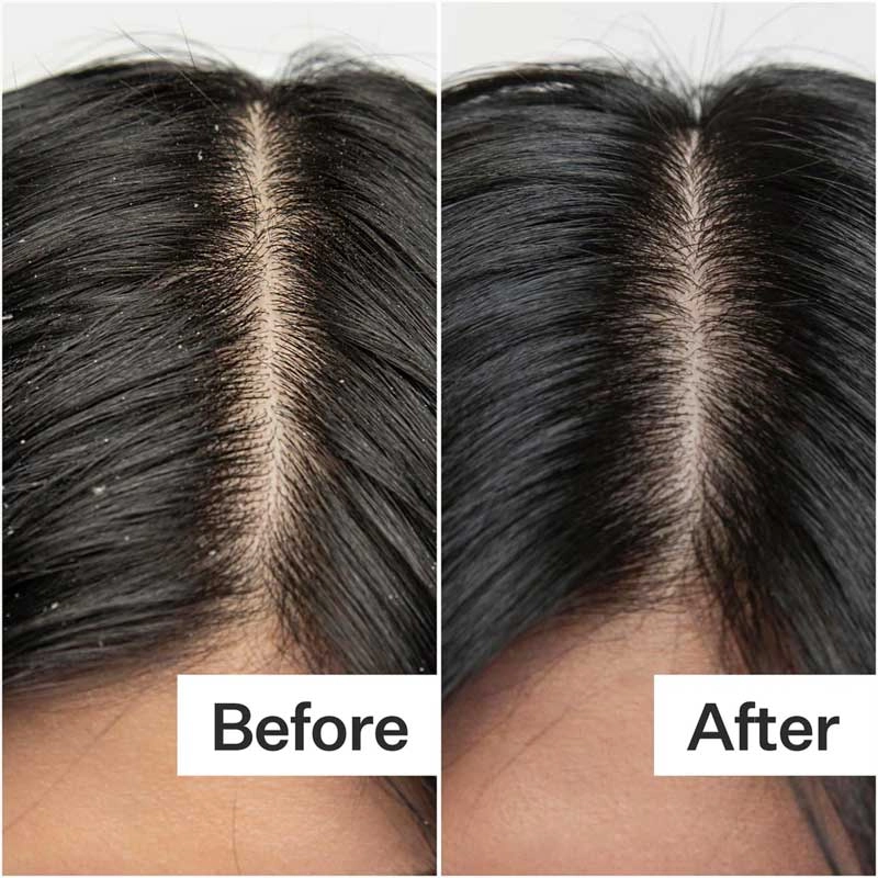 Act Acre Dry   Itchy Scalp System